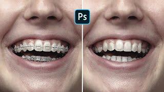 Newest way to remove braces in Photoshop