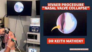 VIVAER PROCEDURE (NASAL VALVE COLLAPSE) WITH DR. KEITH MATHENY, COLLIN COUNTY ENT