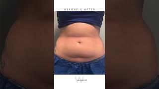 CoolSculpting Before & After 1 treatment