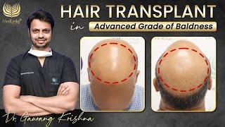 Hair Restoration in Advanced Grade of Baldness | Grade 6, Grade 7 Hair Transplant Results | Medlinks