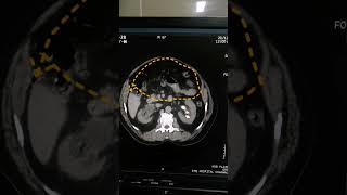 Hydronephrosis | Findings of kidney | Scan of kidney | Medical Imaging | CT Scan | Calculi of kidney