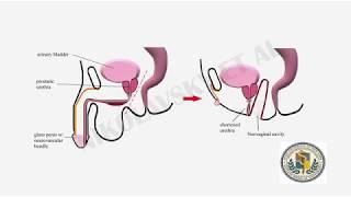 Repair of Prostato-Neovaginal Fistula in Patient with Prior TURP