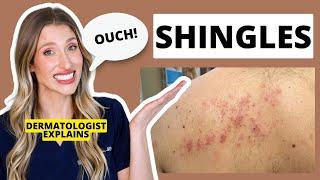 Dermatologist Explains Shingles: Is it Contagious? Shingles Treatments & Prevention? | Dr. Sam Ellis