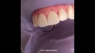 Smile Correction Veneers Placement Procedure by Dr Jignesh Mehta