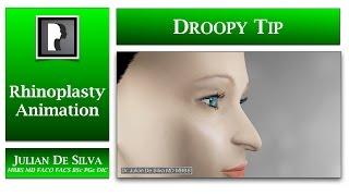 Rhinoplasty Animation How can a Droopy Nasal Tip be lifted?