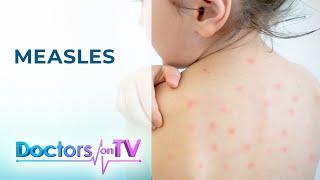 MEASLES: Cause, Symptom, Treatment, and Prevention | DOCTORS ON TV