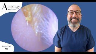 EAR WAX REMOVAL WITH LOTS OF SKIN RIBBONS - EP766