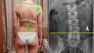 Lateral Pelvic Tilt & Scoliosis (FIX it by THIS...)