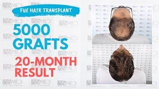 Manual FUE Hair Transplant Before & After 5000 Grafts 20-Month Result - ASMED - Dr. Koray Erdogan