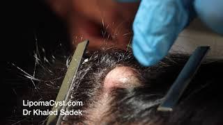 Explosive Pilar Cyst. Dr Khaled Sadek. LipomaCyst.com