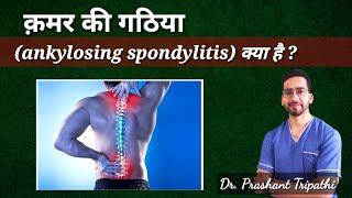 क़मर की गठिया ankylosingspondylitis #lowerbackpain #drprashanttripathi #spinepain #backpainrelief