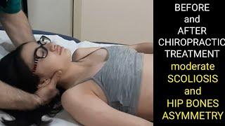 RESULTS of CHIROPRACTIC TREATMENT - scoliosis and hip bones asymmetry chiropractor Evgeni Trigubov