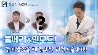 【맞춤형 시술】울쎄라&인모드 같이 받았을 때 결과는? 리얼 시술 후기!!