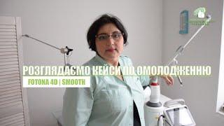 Лазерне омолодження шкіри обличчя | Розглядаємо ТРИ кейси #омолодження #дерматолог #косметолог