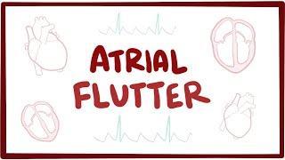 Atrial flutter - causes, symptoms, diagnosis, treatment, pathology
