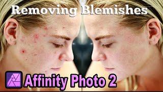 Removing Skin Blemishes in Affinity Photo 2