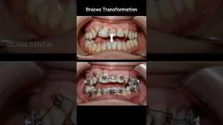 Braces transformation - open bite & crooked teeth #braces #dentist #orthodontist #dental