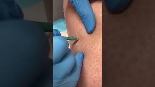 Derm performs skin cancer testing! #skincancer #mole #dermreacts