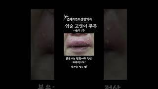 입술 세로주름 한번에 영구교정! #인중주름 #고양이주름 #홍대성형외과  #신촌성형외과 #고양이주름 잘하는곳#연세자연미성형외과 #lipwrinkles #smoker'sline