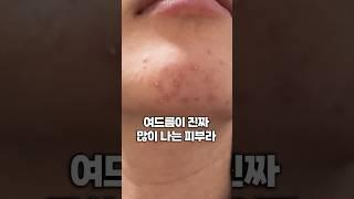 재구매만 N통째 | 색소침착 미백에 효과 본 찐애정템..