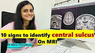 10 signs to identify central sulcus on MRI Brain. Neurosurgery made easy. #braintumor #mribrain