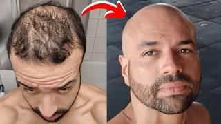 I Was So Scared Of Going Bald...Until I Did This...