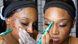 Microneedling at Home | Acne Scars, Dark Spots, Hyperpigmentation ft. Dr Pen A6S