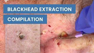 Extraction Satisfaction (Blackhead Removal) | CONTOUR DERMATOLOGY