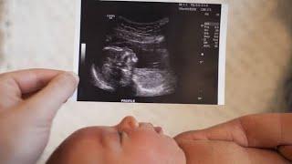 ultrasound of fetus | a baby boy | measurement Age of fetus | breech | doppler ultrasound | blood fl