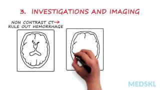 Neurology – Hemiplegia, Hemisensory Loss (With or Without Aphasia): By Ted Wein M.D.