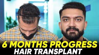 Hair Transplant in Turkey | Best Results & Cost of Hair Transplant in Turkey