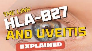 The Link Between HLA B27 and Uveitis Explained