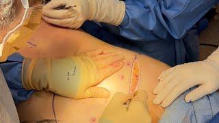 Mommy Makeover | Tummy Tuck & Fat Transfer to the Breasts W/ Lift | Full Surgery | Seattle