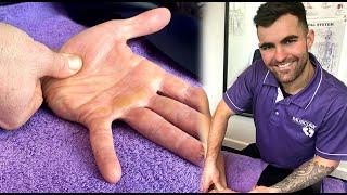 How to treat a THERAPIST’S THUMB | Thenar Muscle Treatment 