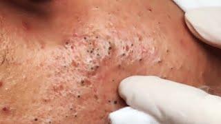 ENJOY YOUR DAY WITH GA SPA PART I #relaxing  #blackheads