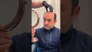 Before and after hair transplant #worbimed #hairtransplant #hairtransplantturkey