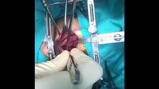 Complete cleft palate repair video