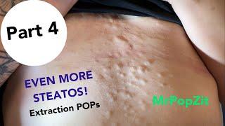 Even more Steatocystomas!Part 4 of clearing the bumps from her chest. Look for the cashew Steato sac