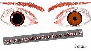 Pupil besar sebelah, Anisocoria