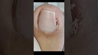 trimming nail ingrown at home