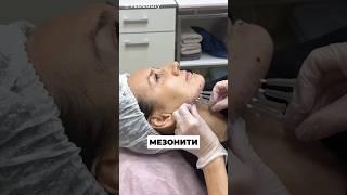 Укрепление кожи лица армируюшими мезонитями #косметология