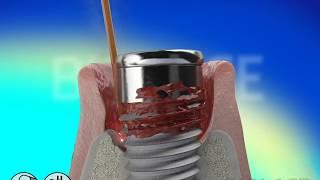 How laser works on ALL-ON-4 implant infections