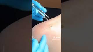 Shave biopsy preformed by Dr. John Tedesco