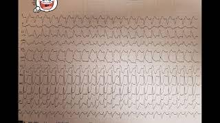 Dopovedanie prípadu širokokomplexovej tachykardie z 08.11.17