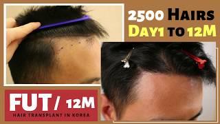 【韓國FUT植髮分享】 FUT植髮│2500根│術后12個月效果│FUT Follicular unit transplantation│Hair transplant in Korea