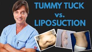 Liposuction vs. Tummy Tuck with Dr. John Bergeron