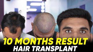 Hair Transplant in Chennai  | Best Results & Cost of Hair Transplant in Chennai