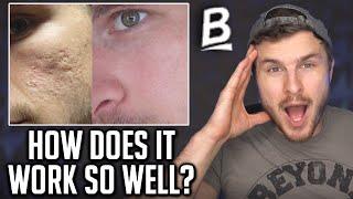 MY ACNE SCAR RESULTS | What's In A Banish Starter Kit?