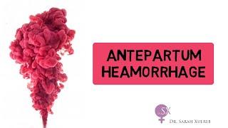 Antepartum Haemorrhage