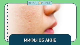 #НАЗДОРОВЬЕ: мифы об акне